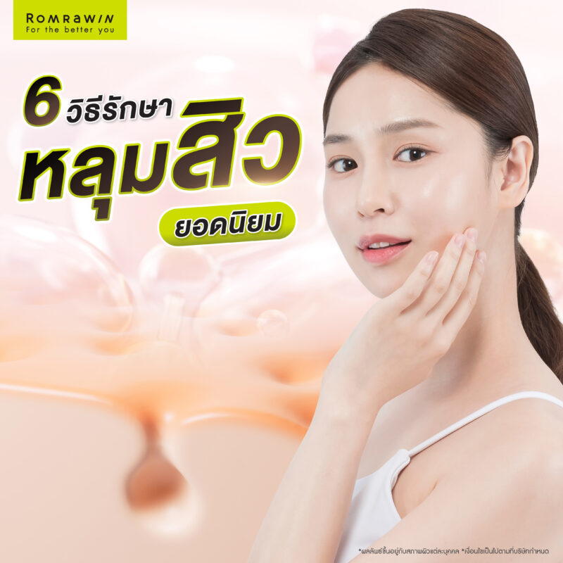 รวม 6 วิธีรักษาหลุมสิวยอดนิยม