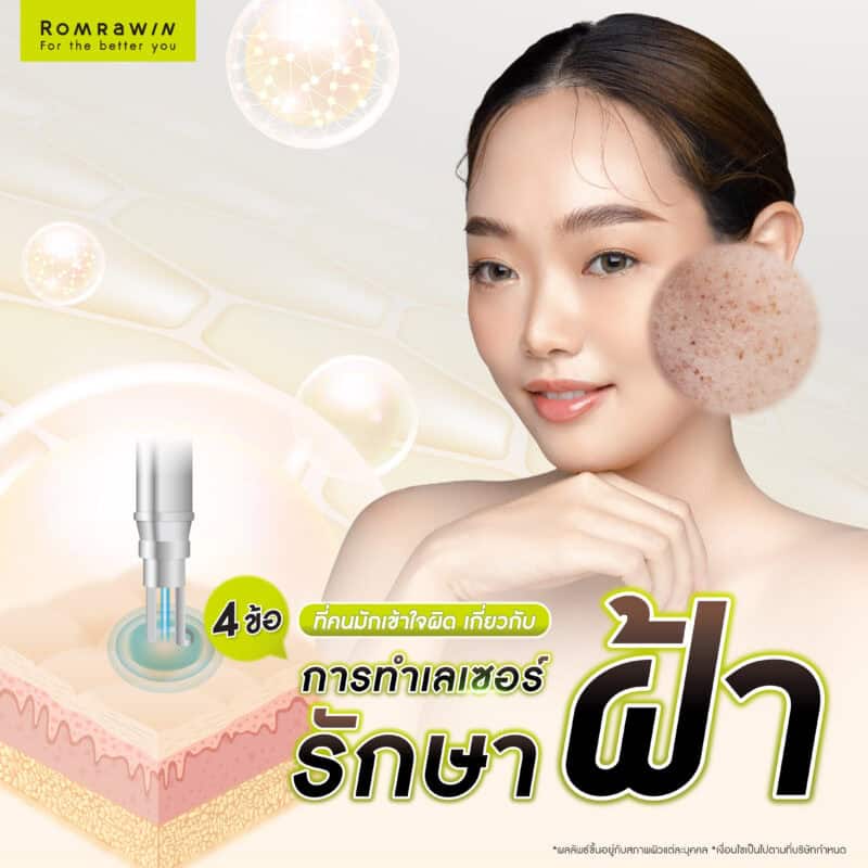 4 ข้อที่คนมักเข้าใจผิด เกี่ยวกับการทำเลเซอร์รักษาฝ้า