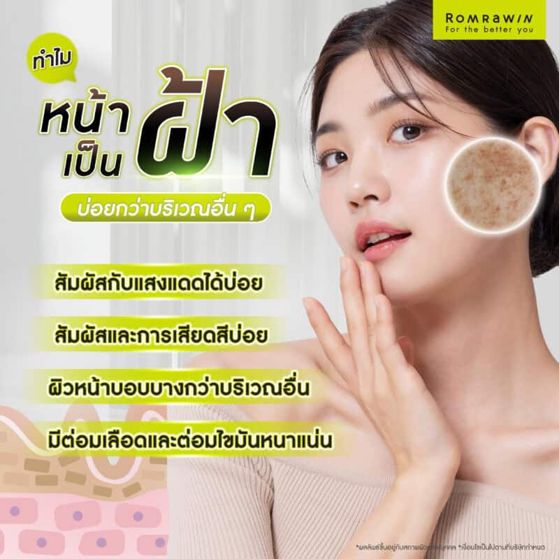 ทำไมหน้าเป็นฝ้าบ่อยกว่าบริเวณอื่น ๆ ในร่างกาย