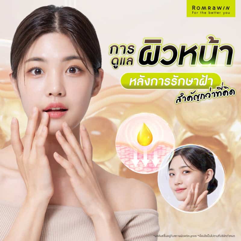 การดูแลหน้าเป็นฝ้าหลังการรักษาสำคัญกว่าที่คิด