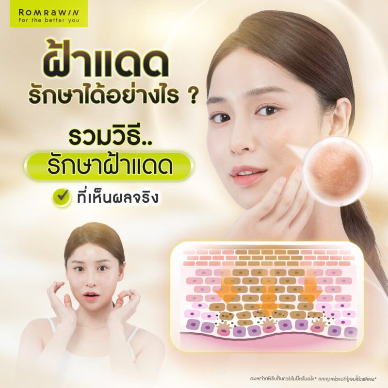 ฝ้าแดดรักษาได้อย่างไร ? รวมวิธีรักษาฝ้าแดดด้วยวิธีต่าง ๆ