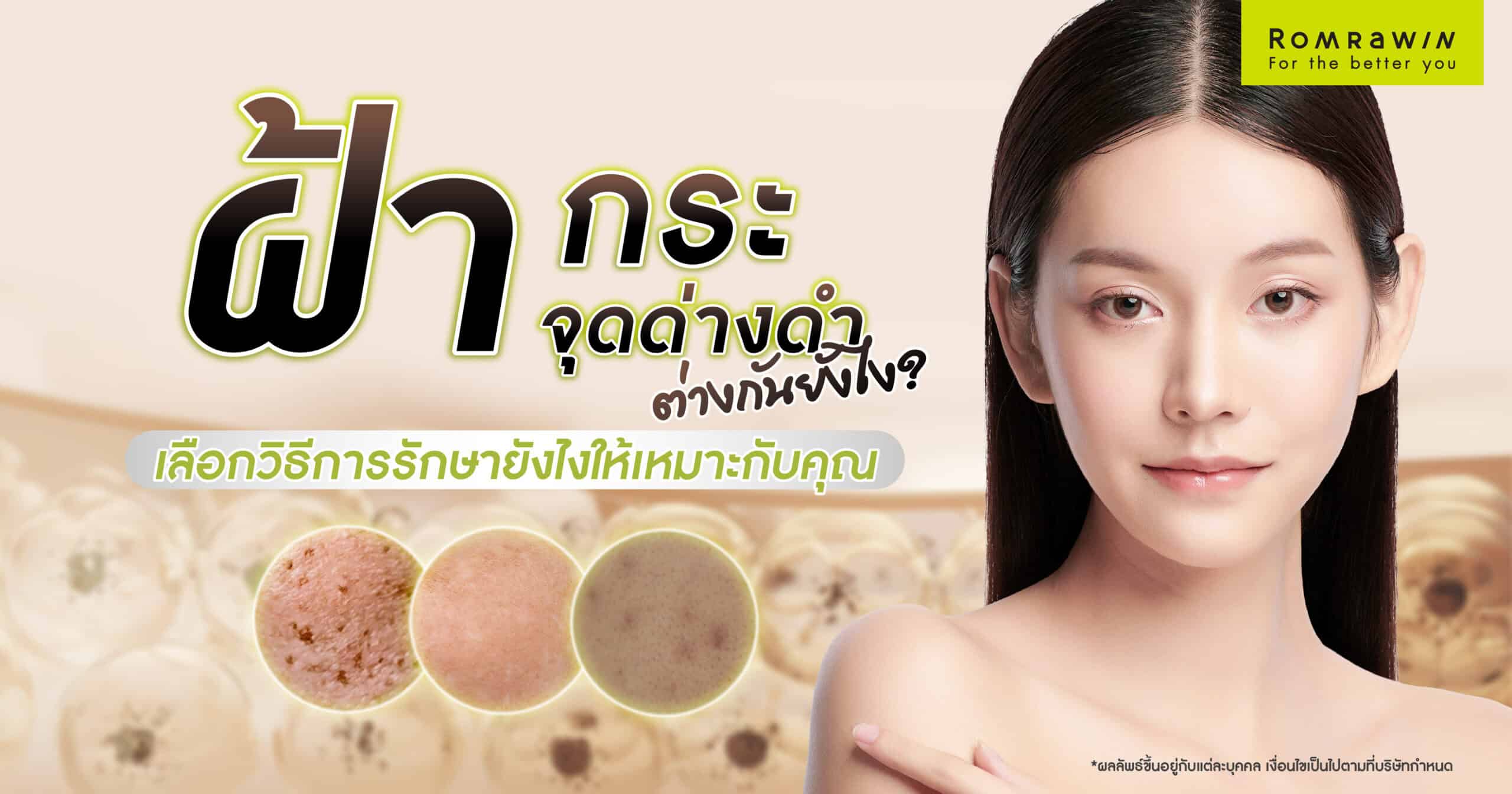 ฝ้า กระ จุดด่างดำ