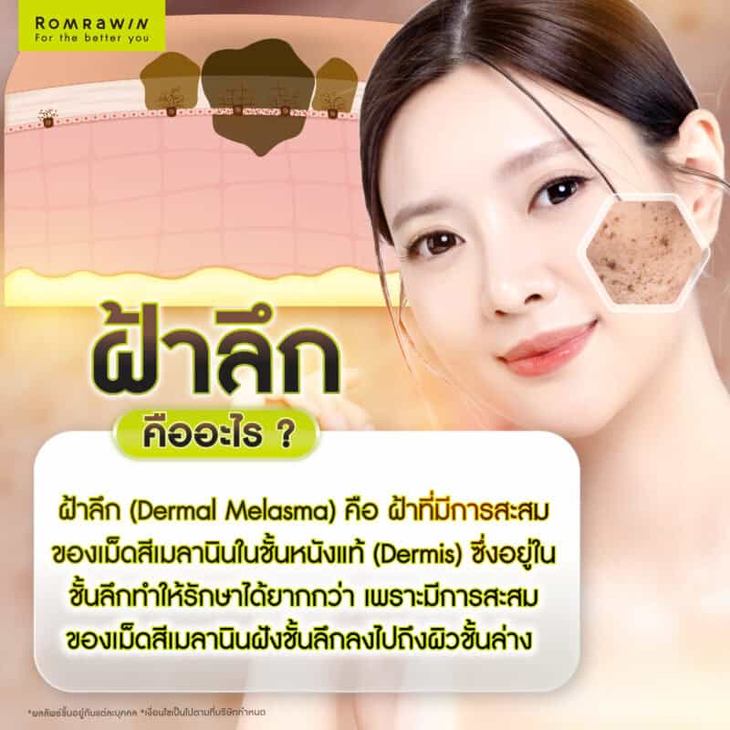 ฝ้าลึกคืออะไร ?