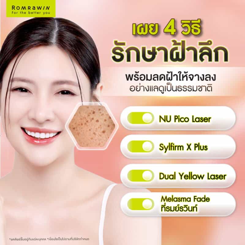 เผย 4 วิธีรักษาฝ้าลึก พร้อมลดฝ้าให้จางลงอย่างแลดูเป็นธรรมชาติ