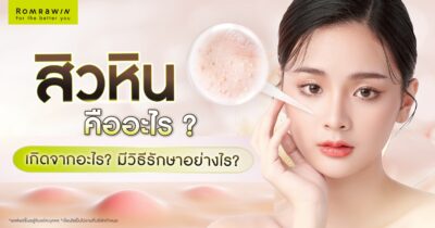 สิวหินคืออะไร