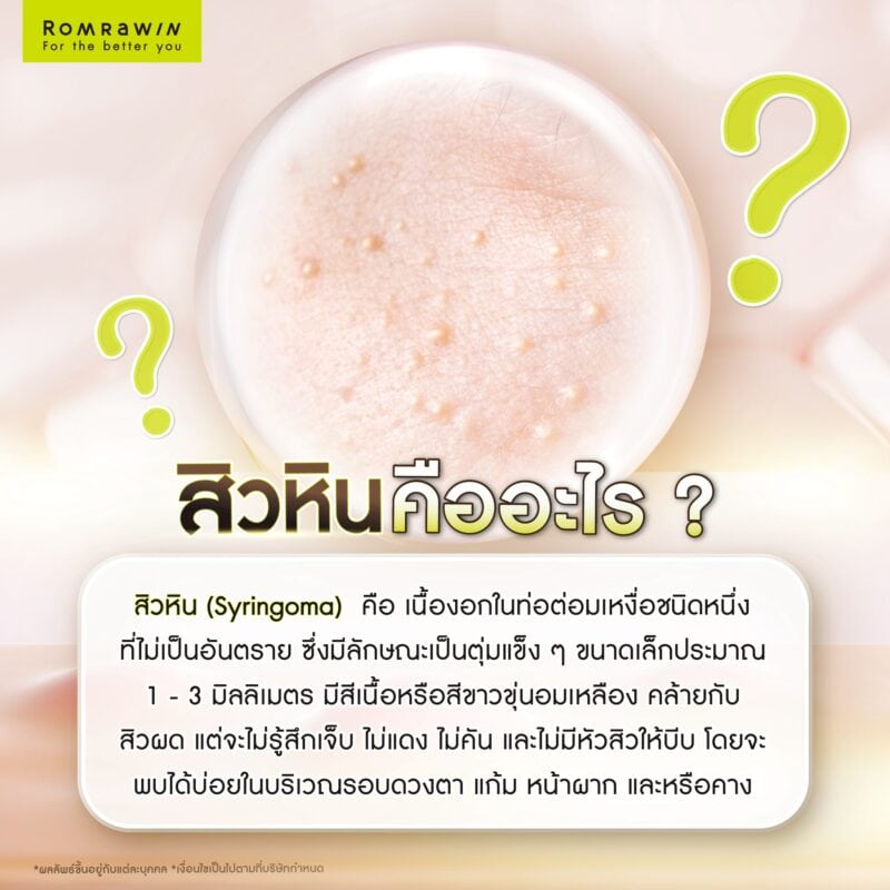 สิวหินคืออะไร?
