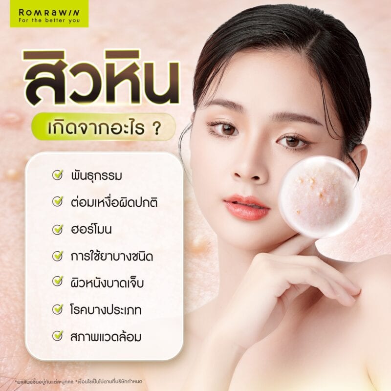 สิวหินเกิดจากอะไร?