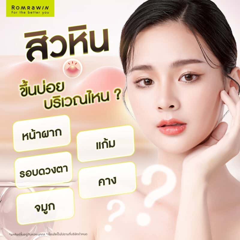 บริเวณไหนที่เกิดสิวหินบ่อย?