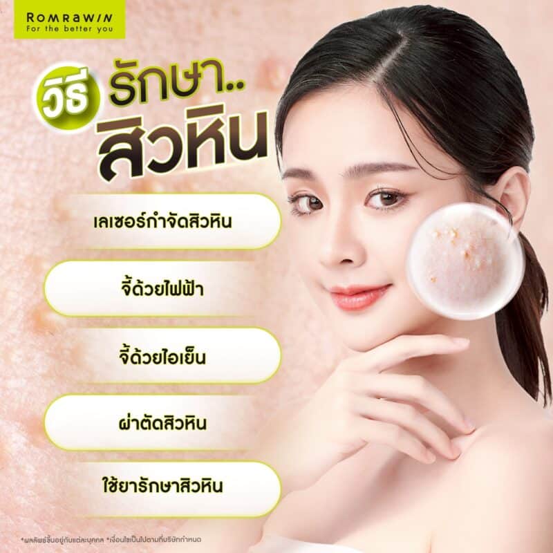 วิธีรักษาสิวหิน