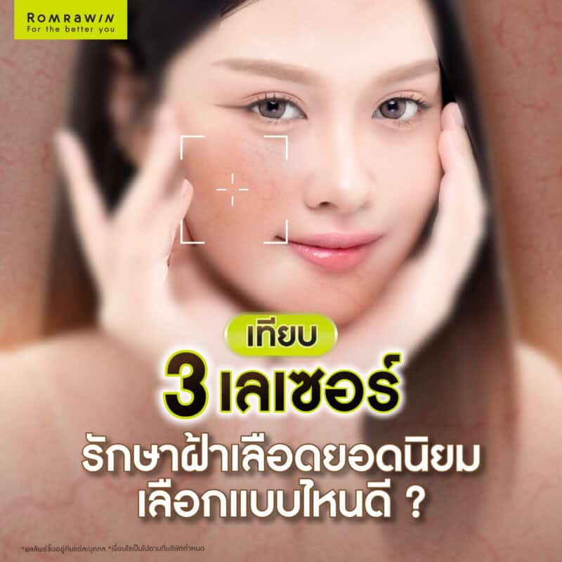 เทียบเลเซอร์รักษาฝ้าเลือด 3 แบบยอดนิยม เลือกแบบไหนดี ?