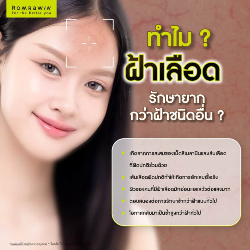 ทำไมฝ้าเลือดรักษายากกว่าฝ้าชนิดอื่น ?