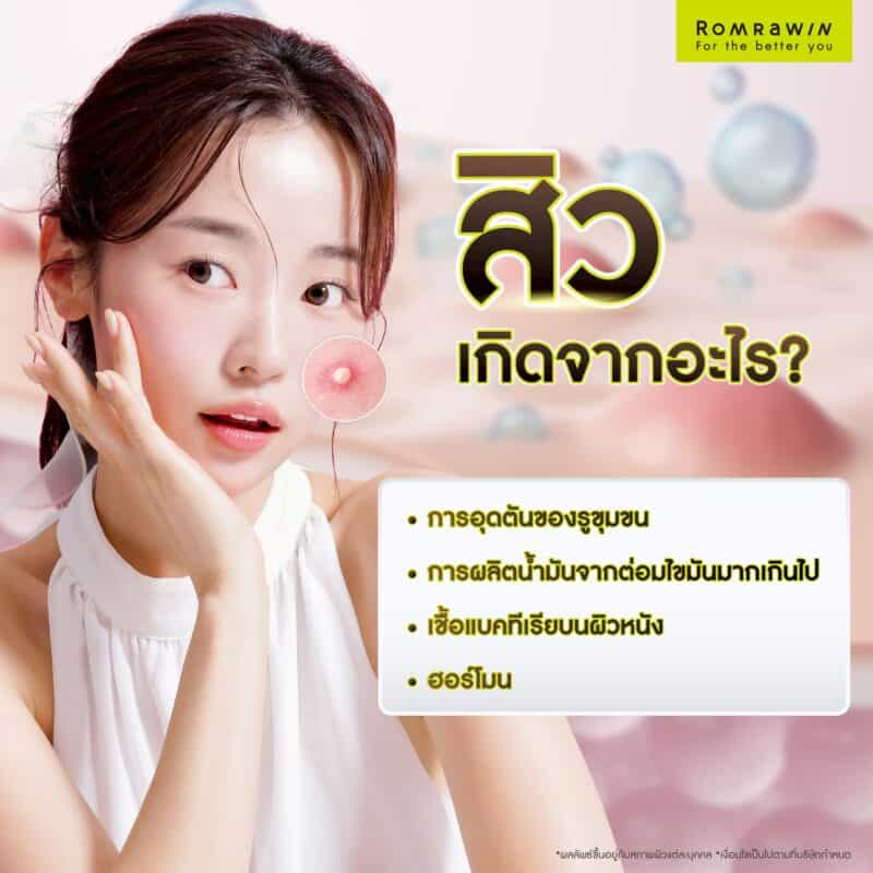 สิวเกิดจากอะไร ?