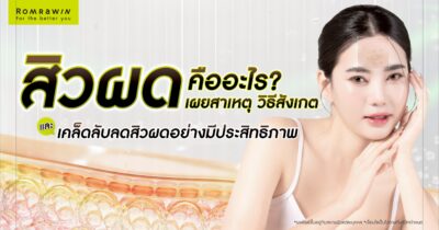 สิวผด คืออะไร