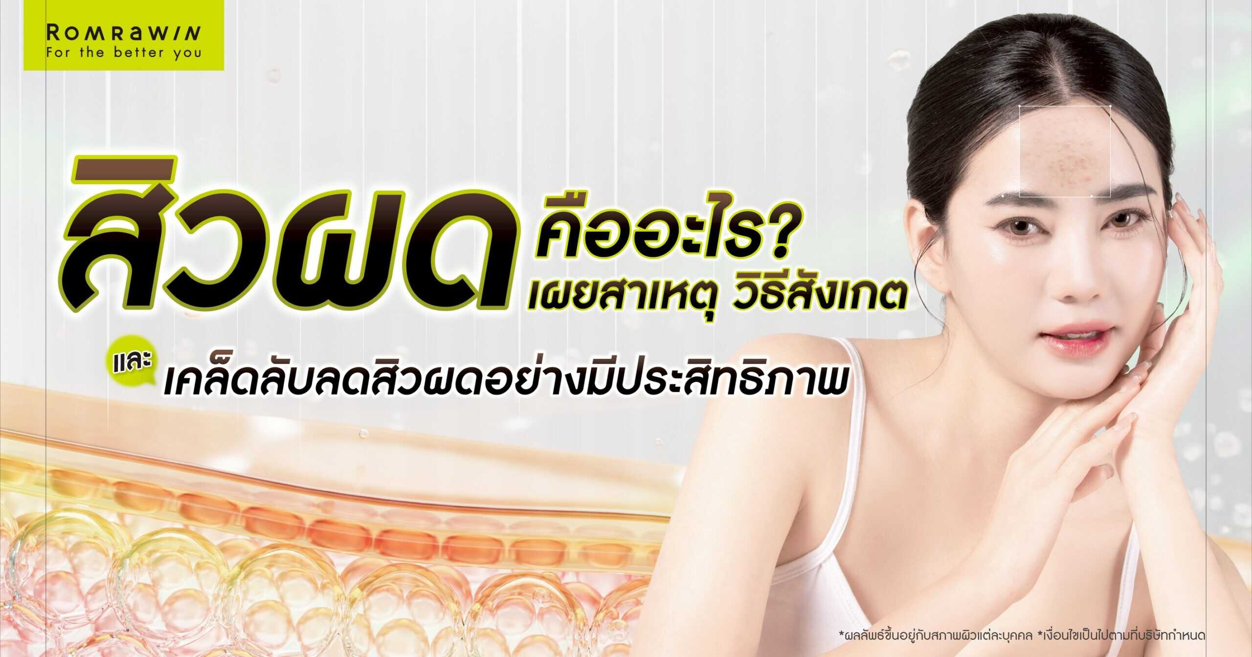 สิวผด คืออะไร