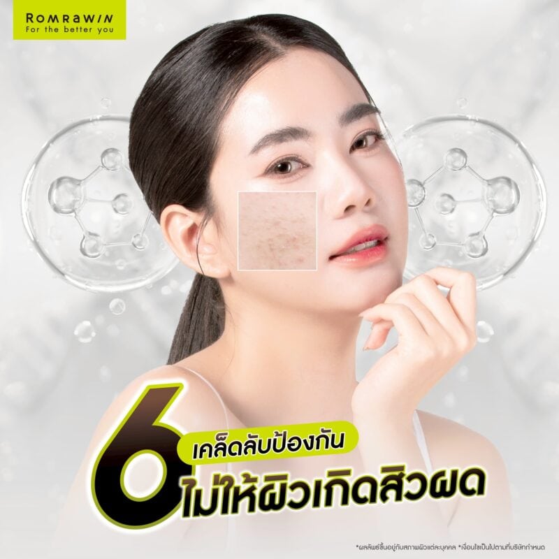 6 เคล็ดลับป้องกันไม่ให้ผิวเกิดสิวผด คืออะไรบ้าง?