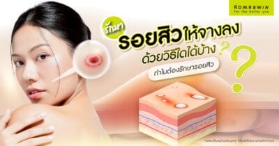 รักษารอยสิว