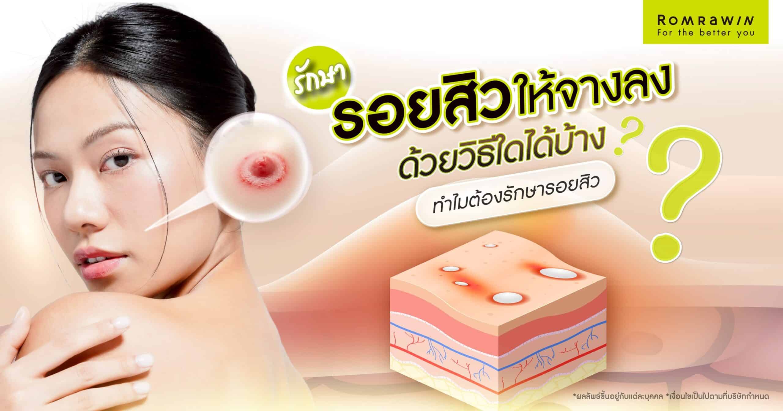 รักษารอยสิว