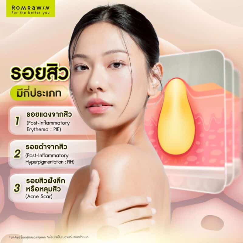 รอยสิวมีกี่ประเภท 