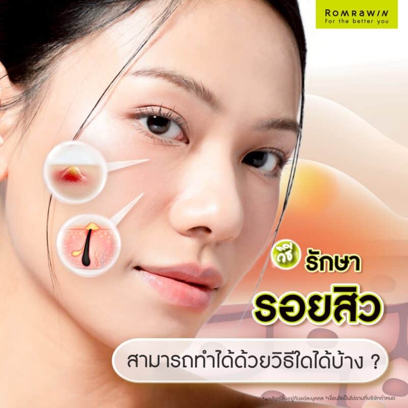 รักษาการรักษารอยสิว สามารถทำได้ด้วยวิธีใดได้บ้าง ?