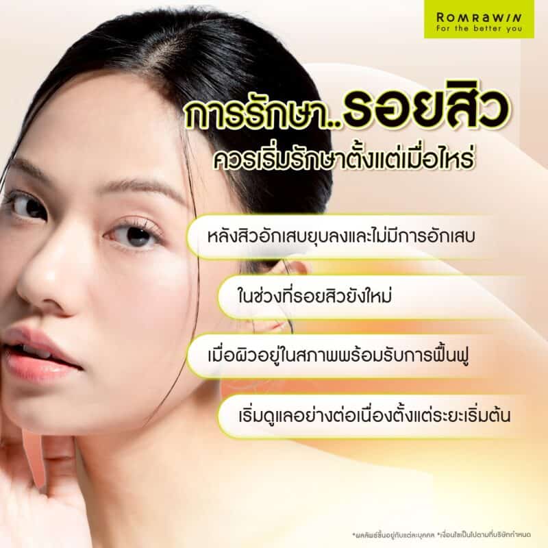 การรักษารอยสิวควรเริ่มรักษาตั้งแต่เมื่อไหร่ 