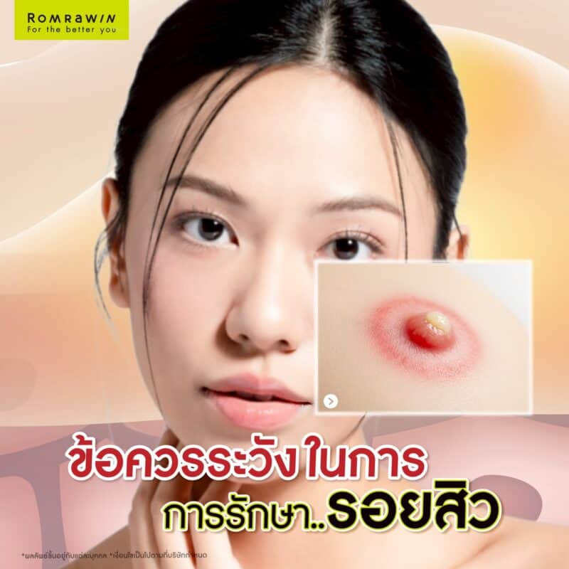 ข้อควรระวังในการรักษารอยสิว