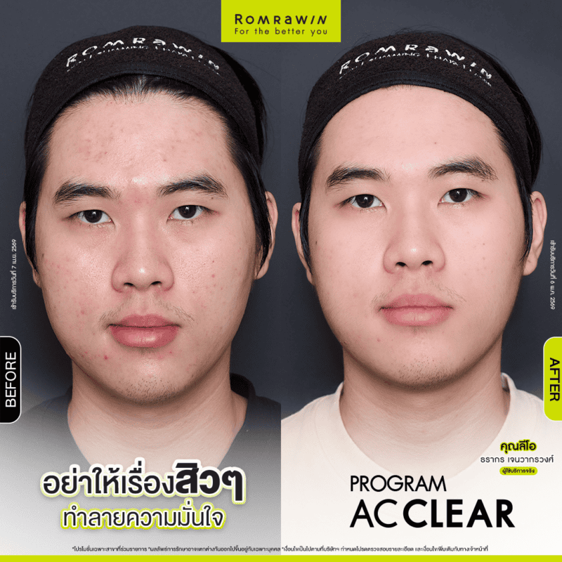 ผลลัพธ์ขึ้นอยู่กับแต่ละบุคคล