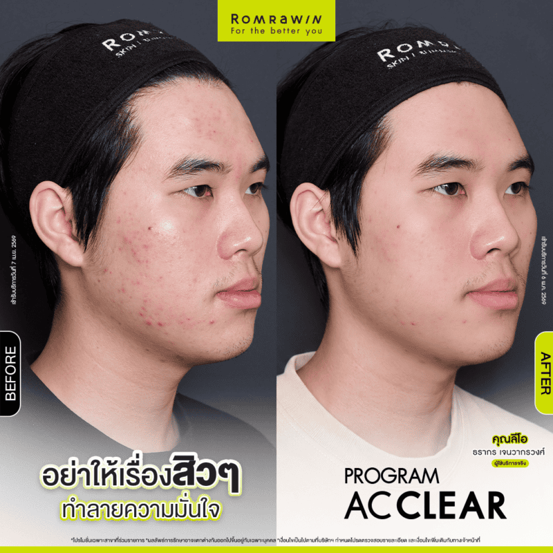 ผลลัพธ์ขึ้นอยู่กับแต่ละบุคคล