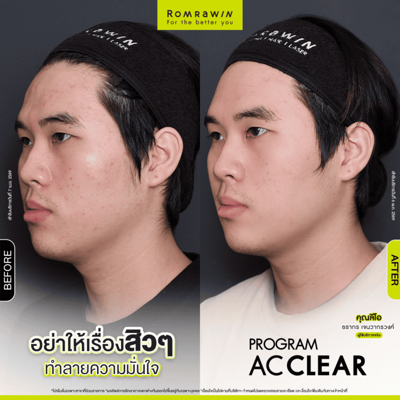 ผลลัพธ์ขึ้นอยู่กับแต่ละบุคคล