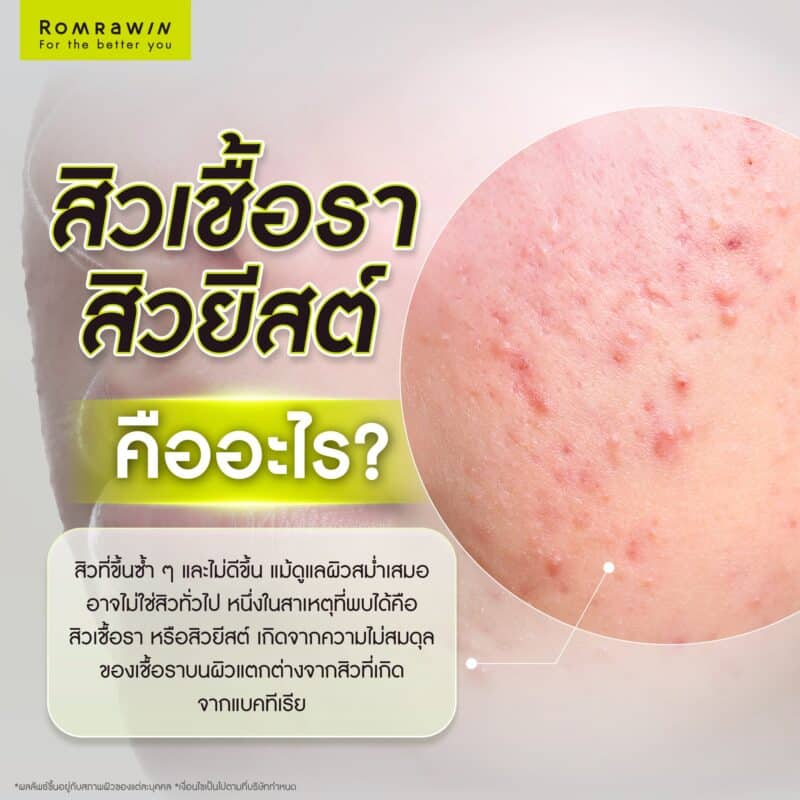 สิวเชื้อรา สิวยีสต์ คืออะไร?