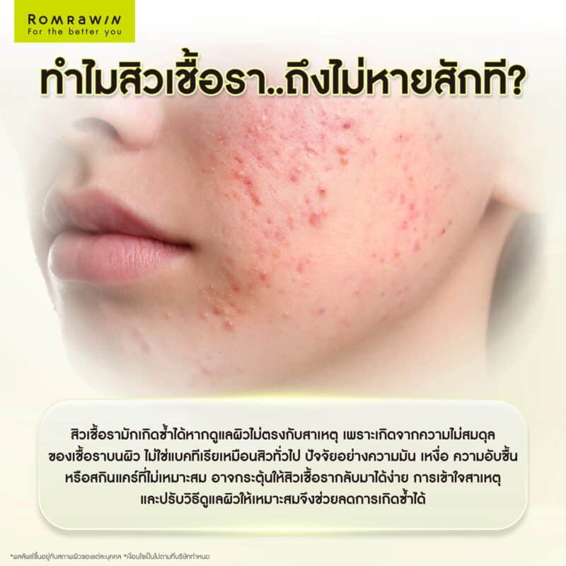 ทำไมสิวเชื้อราถึงไม่หายสักที?