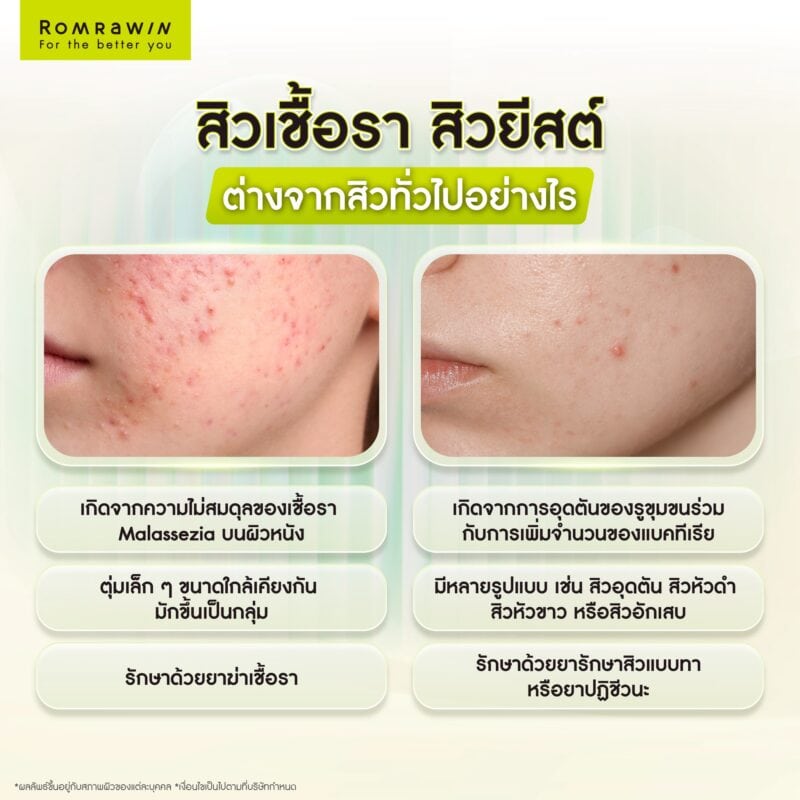 สิวเชื้อรา สิวยีสต์ ต่างจากสิวทั่วไปอย่างไร