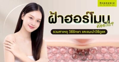 ฝ้าฮอร์โมน