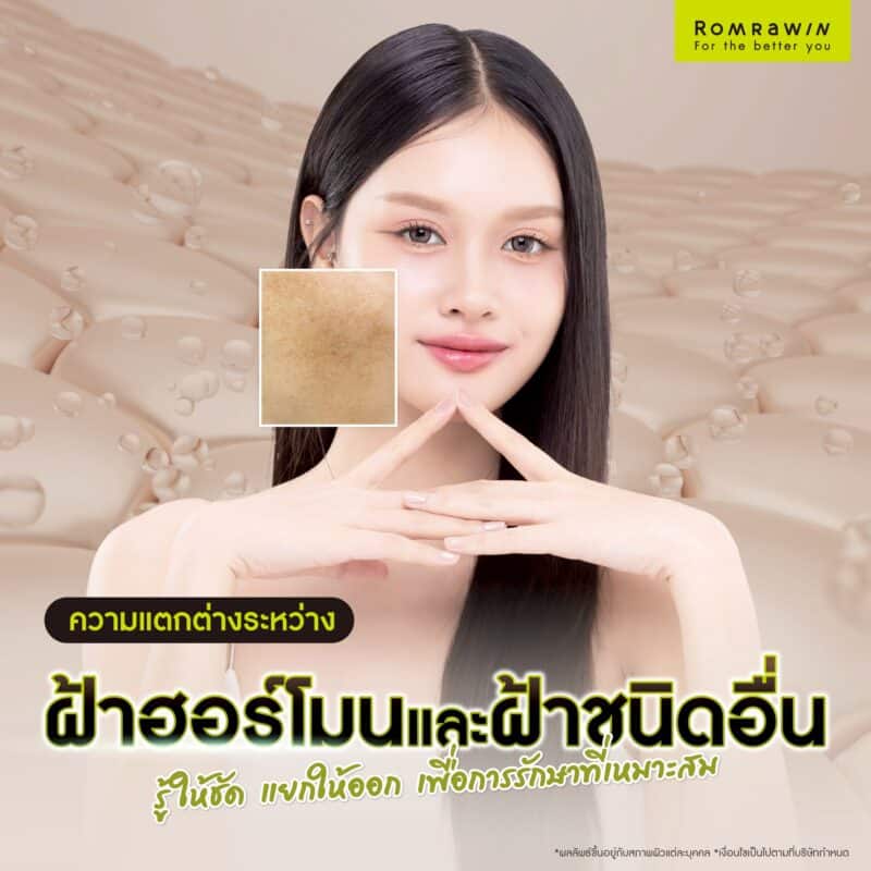 ความแตกต่างระหว่างฝ้าฮอร์โมนและฝ้าชนิดอื่น รู้ให้ชัด แยกให้ออก เพื่อการรักษาที่เหมาะสม