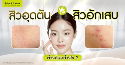 สิวอุดตันกับสิวอักเสบ