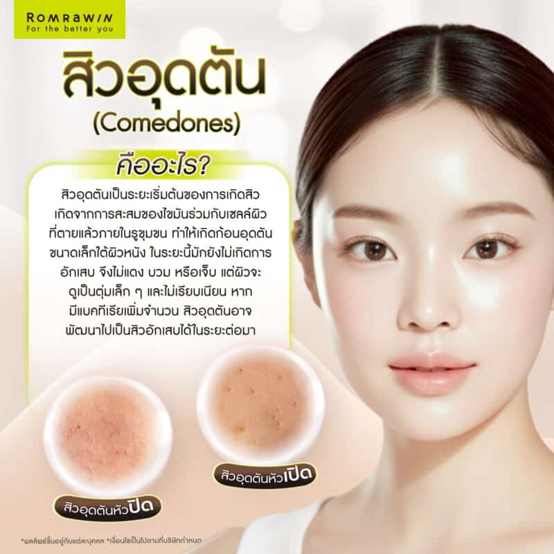 สิวอุดตัน (Comedones) คืออะไร?