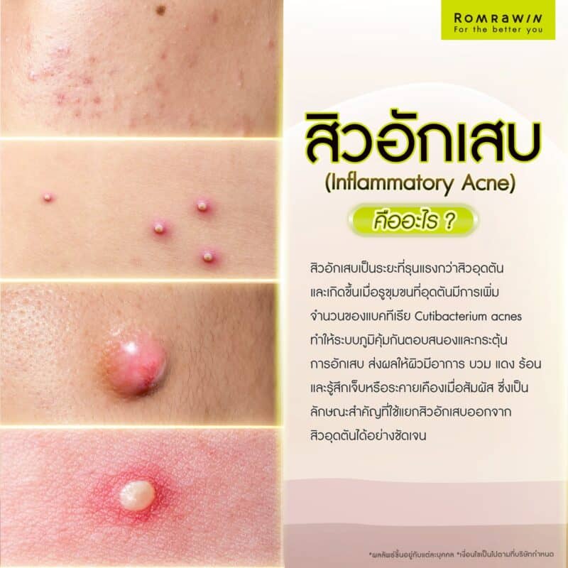 สิวอักเสบ (Inflammatory Acne) คืออะไร?
