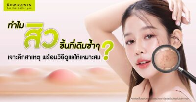 ทำไมสิวขึ้นที่เดิมซ้ำๆ