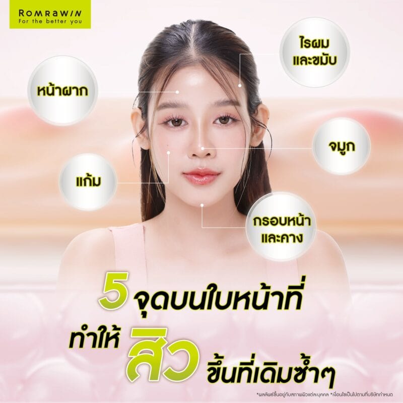 5 จุดบนใบหน้าที่ทำไมสิวขึ้นที่เดิมซ้ำๆ