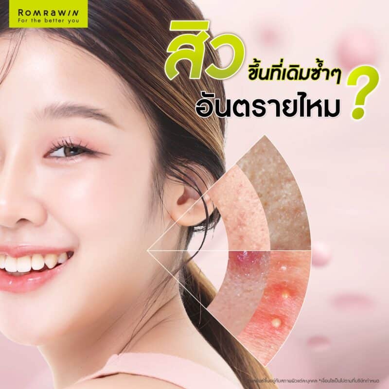 สิวขึ้นที่เดิมซ้ำๆ อันตรายไหม?