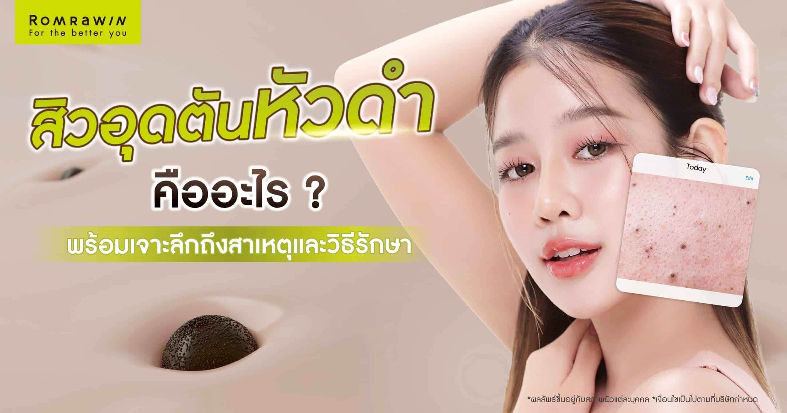 สิวอุดตันหัวดำ
