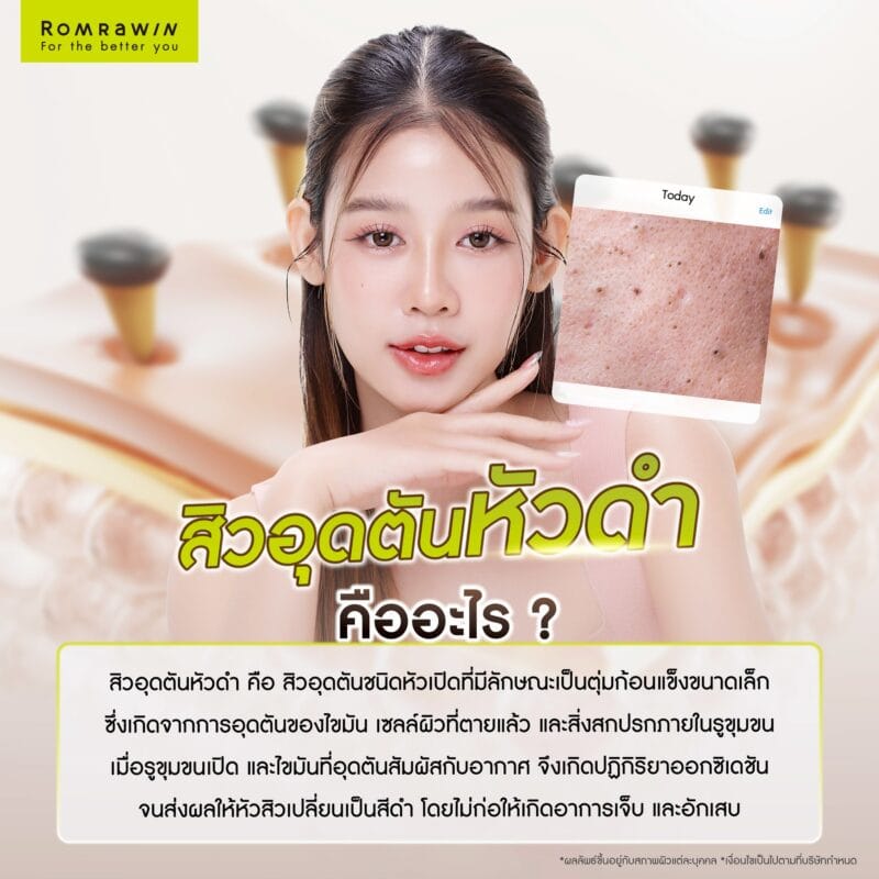 สิวอุดตันหัวดำคืออะไร?