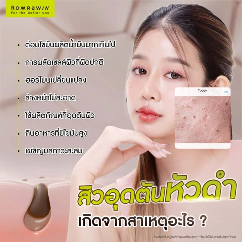 สิวอุดตันหัวดำเกิดจากสาเหตุอะไร?