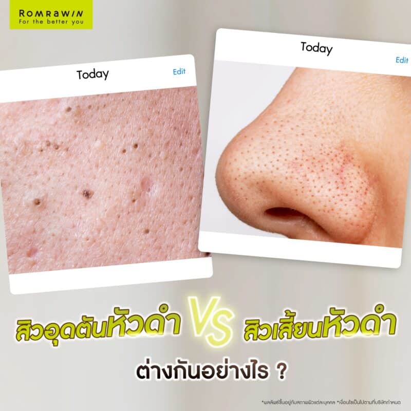 สิวอุดตันหัวดำ กับ สิวเสี้ยนหัวดำ ต่างกันอย่างไร?