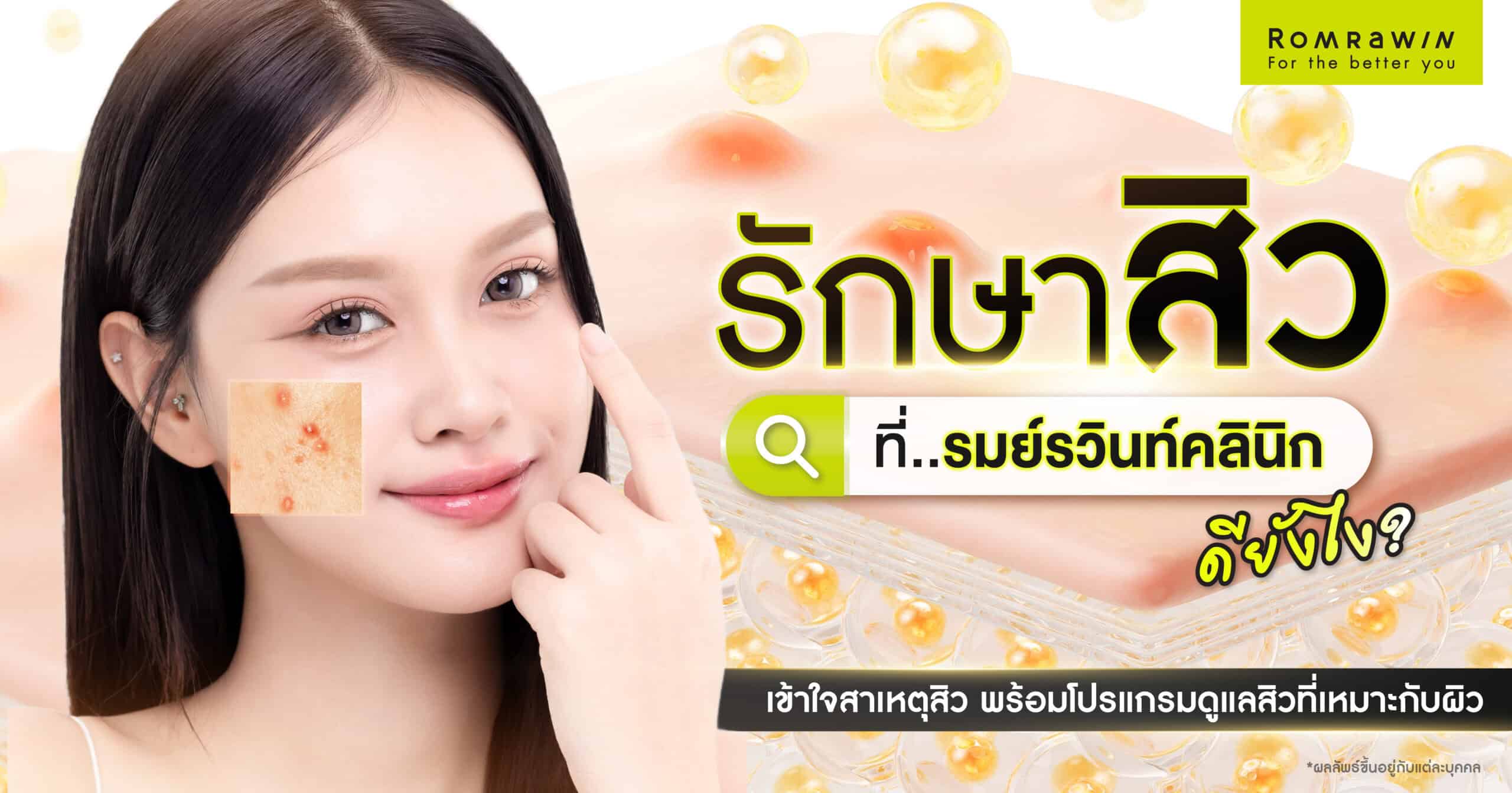 รักษาสิวที่รมย์รวินท์ดียังไง
