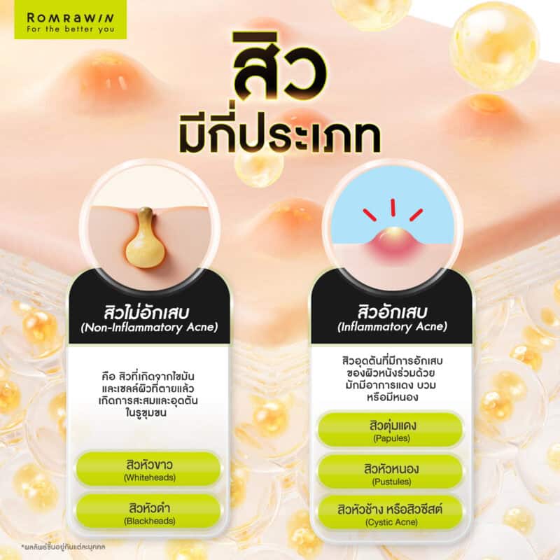 สิวมีกี่ประเภท