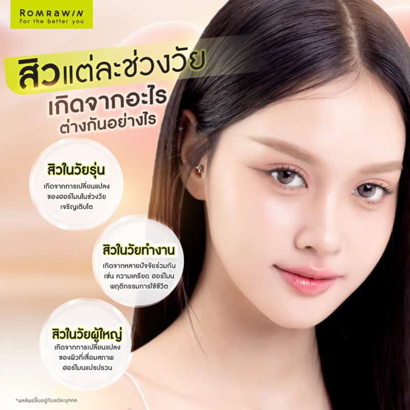 สิวแต่ละช่วงวัย เกิดจากอะไรต่างกันอย่างไร