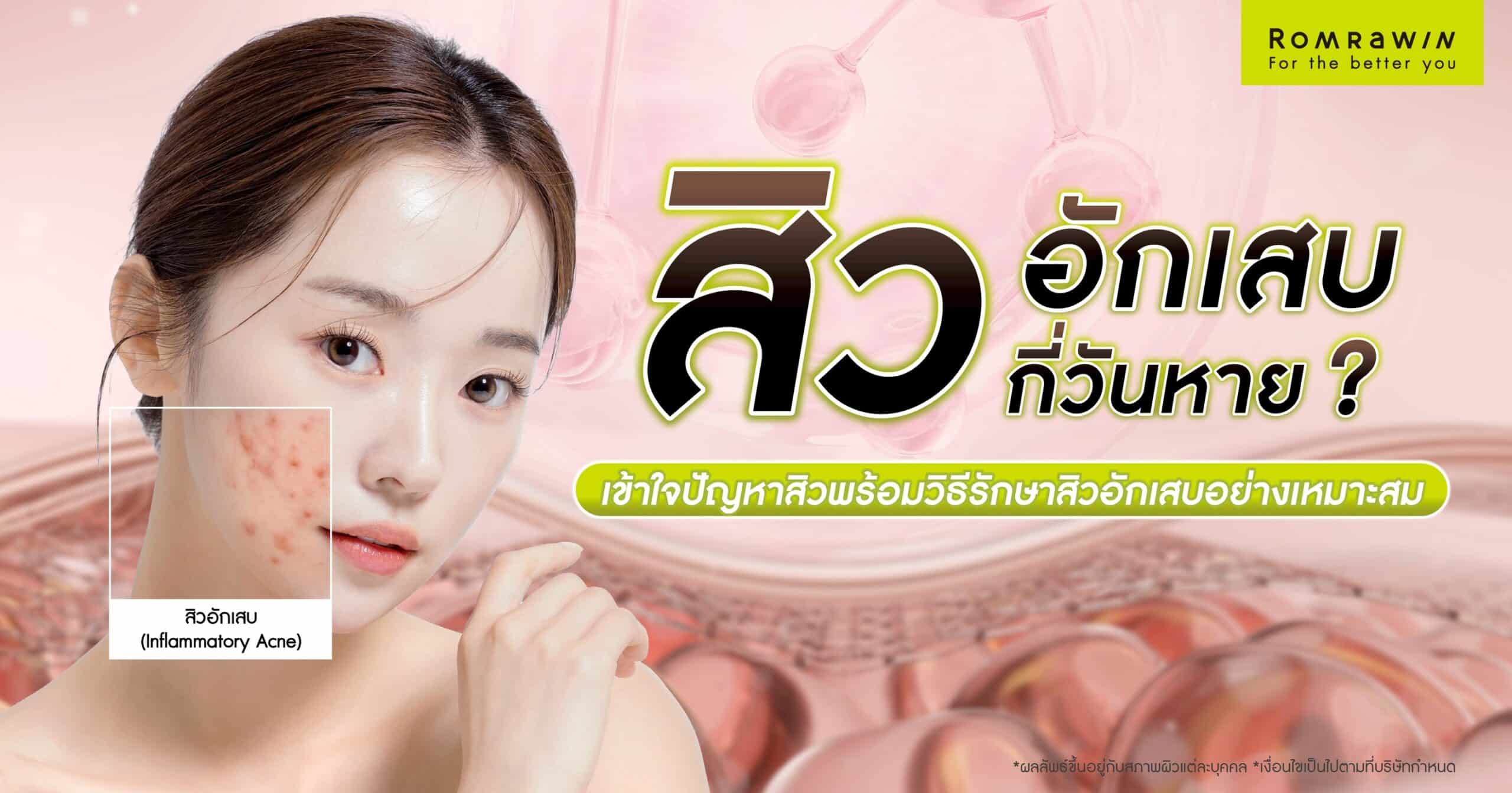 สิวอักเสบกี่วันหาย