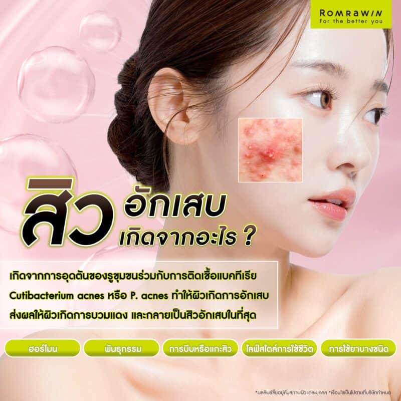 สิวอักเสบเกิดจากอะไร?