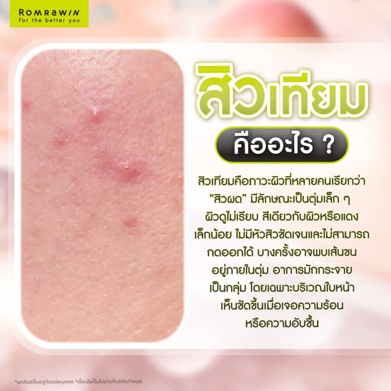 สิวเทียมคืออะไร