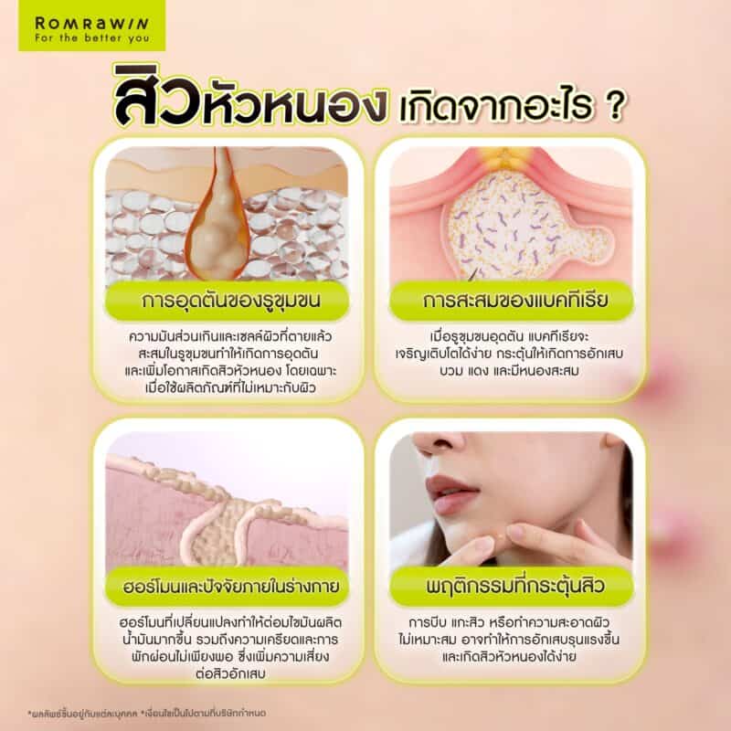 สิวหัวหนอง เกิดจากอะไร?